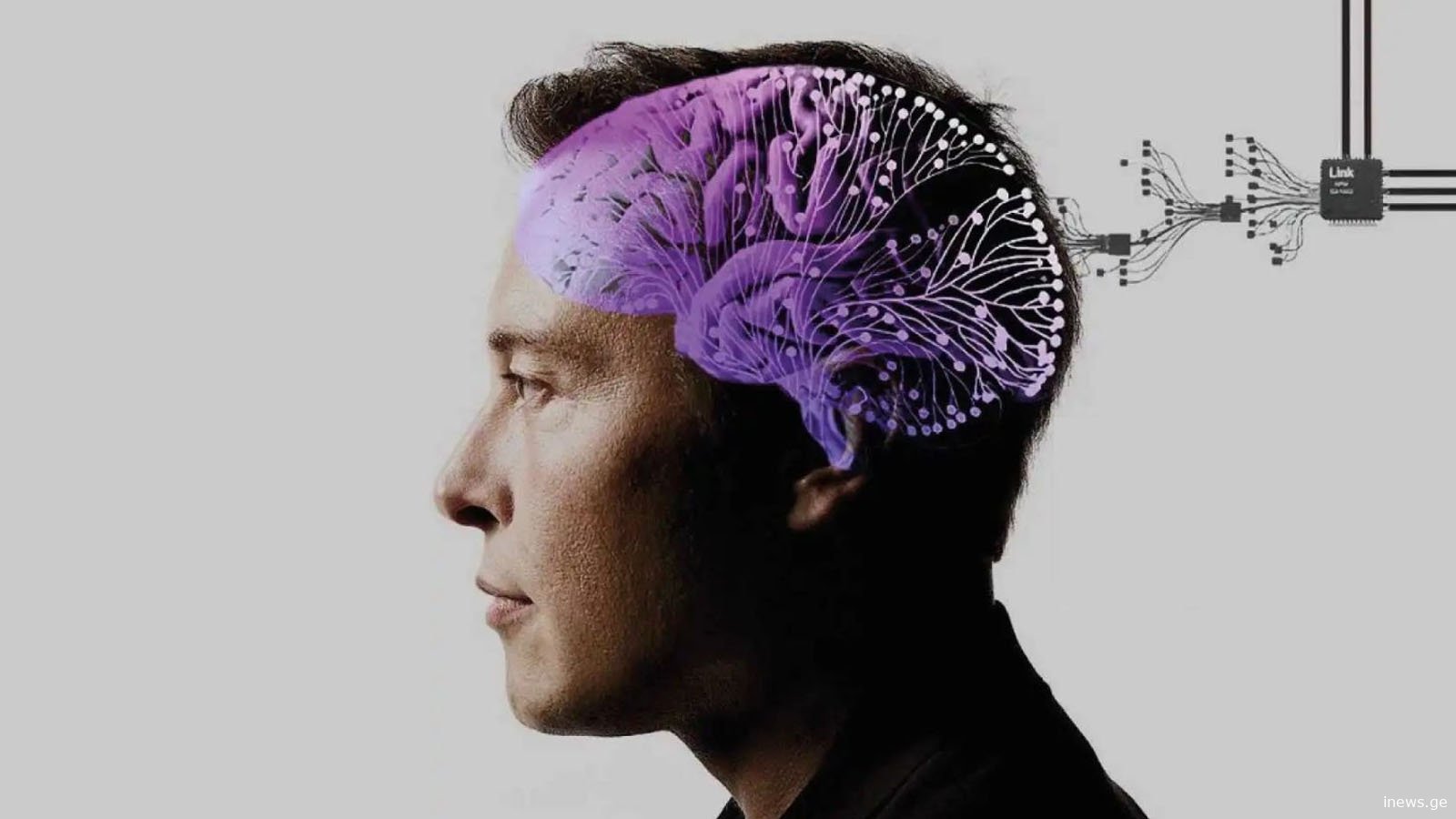 მასკის კომპანია ტვინის იმპლანტის ადამიანებზე გამოსაცდელად მზადაა - რას მოიცავს პროცედურა