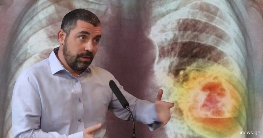 ებრაელი ექიმი გვიყვება როგორ აღმოვაჩინოთ კიბო ადრეულ სტადიაზე, ამით სიცოცხლეს გადაარჩენენ