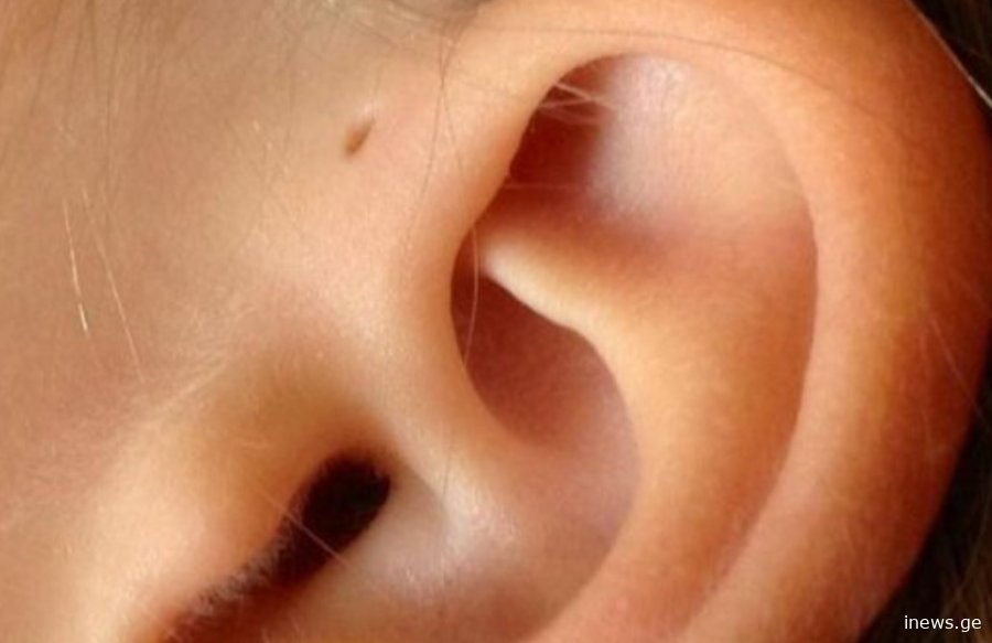 გაფიქრებაც რთული იყო - ას ნიშნავს ეს პატარა ხვრელი ყურზე, ძალიან ბევრს აქვს და უმრავლესობამ არ იცის