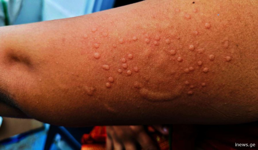 რამდენად საშიშია მაიმუნის ყვავილი ადამიანისთვის და რა უნდა ვიცოდეთ დაავადების შესახებ