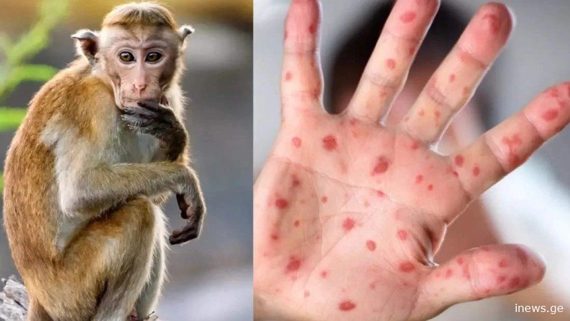 არსებობს თუ არა საქართველოში მაიმუნის ყვავილის გავრცელების საფრთხე - ბოლო ინფორმაცია