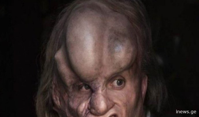 მეცნიერებმა ლეგენდარული სპილო-ადამიანის გვამი აღმოაჩინეს