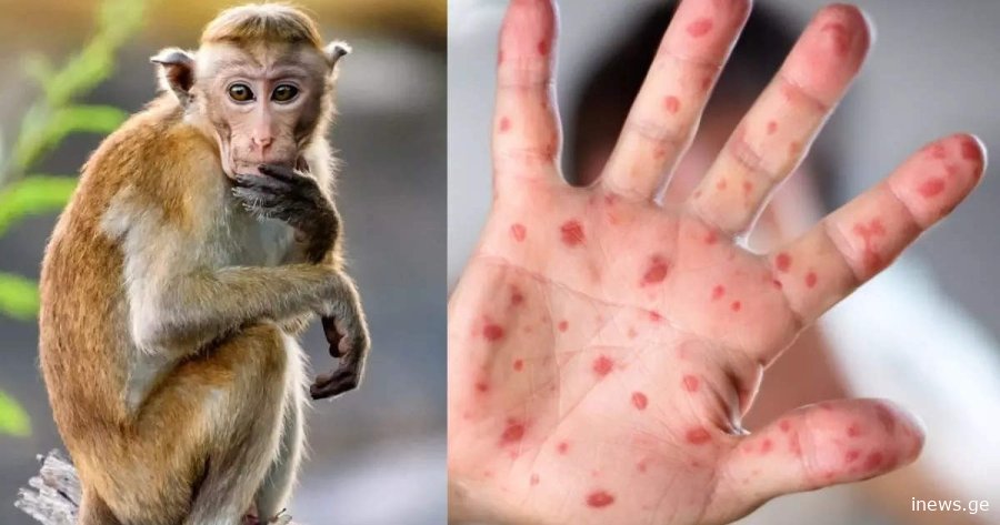 "აზერბაიჯანში მაიმუნის ყვავილის პირველი შემთხვევა დაფიქსირდა! ეს პირველი შემთხვევაა, რაც პოტენციურ რისკს ქმნის, რომ საქართველო..", -  რას წერს გიორგი ფხაკაძე