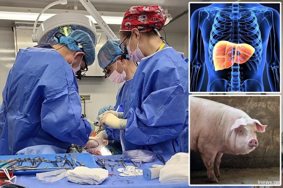 ადამიანს ღორის ღვიძლი წარმატებით გადაუნერგეს — პირველად ისტორიაში