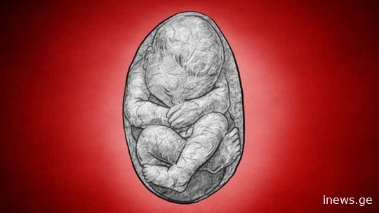 ქვის ბავშვი - ქალი, რომელმაც მუცელში მიცვალებული ნაყოფი 35 წელი ატარა