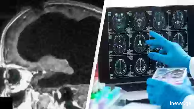 როგორ აღმოაჩინეს ექიმებმა უტვინო მამაკაცი, რომელსაც არაფერი აწუხებდა