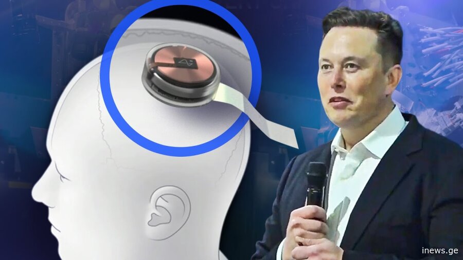 ილონ მასკის ახალი გარღვევა - Neuralink-ის ტვინის ჩიპები ადამიანს სუპერძალებს შესძენს