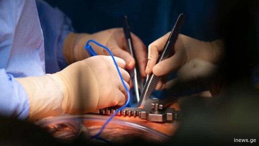 ჩვილისთვის გადასანერგი გული ექიმებმა საოპერაციო მაგიდაზევე გააცოცხლეს