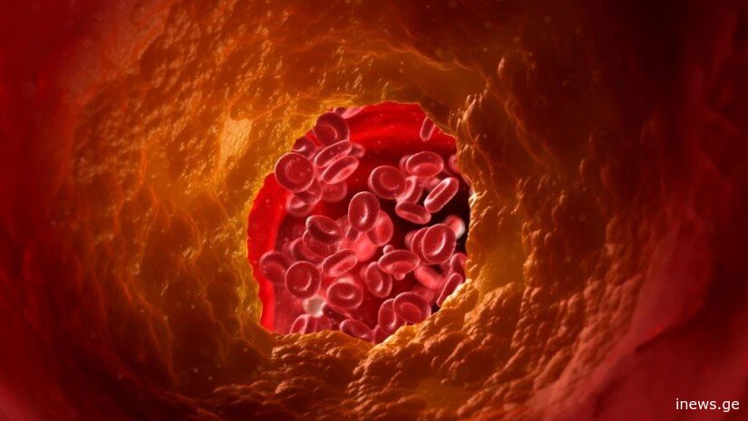 სასმელი, რომელიც ქოლესტერინს დაბლა წევს - ეს უნდა იცოდეთ